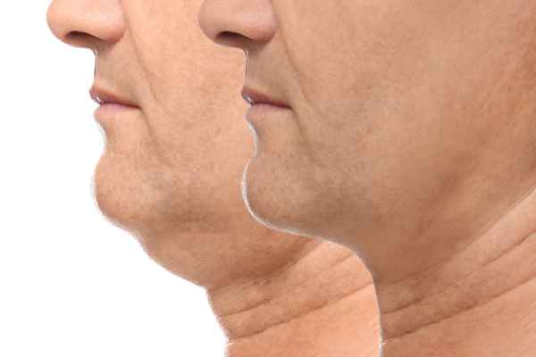HIFU - Breakthrough in Anti - ageing 2 hifu results Hertford