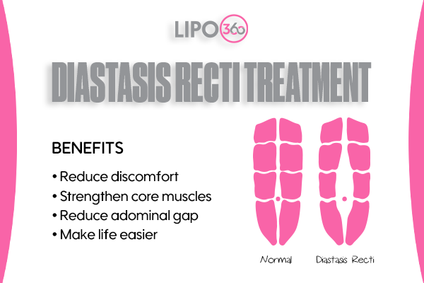 Revolutionising Muscle Repair: The Power of LIPO360 Body Sculpt Post-Injury 5 diastasis recti treatment Hertford