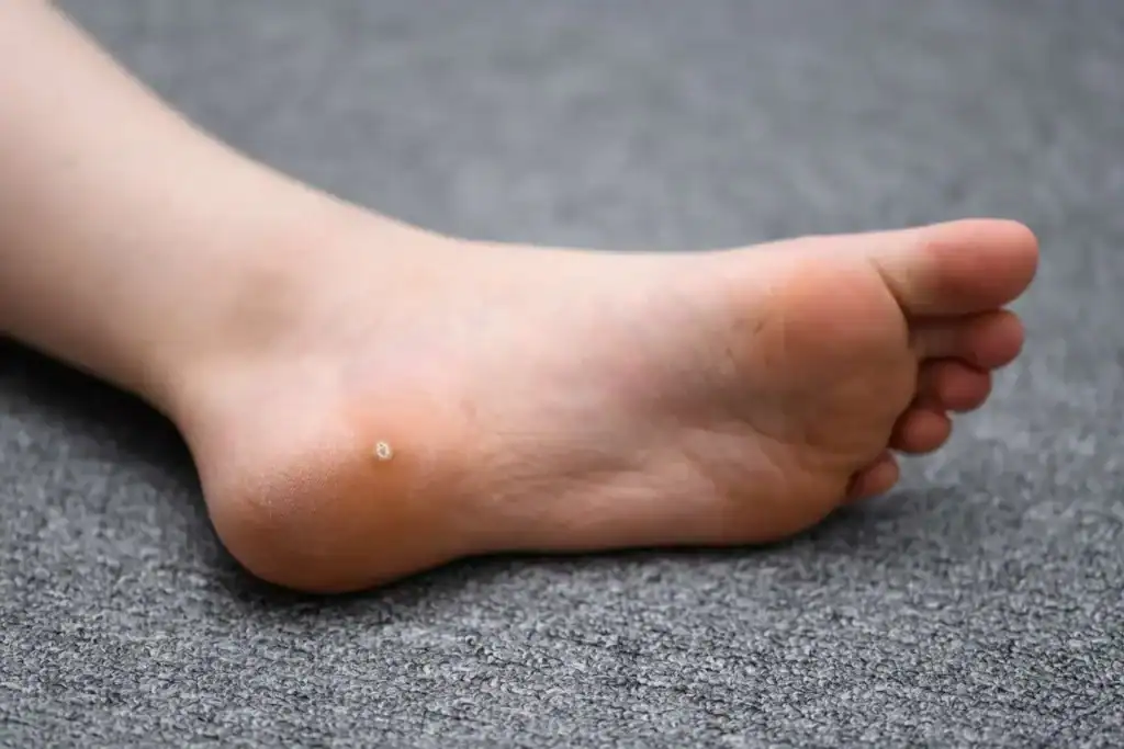 Cryotherapy For Warts And Also Verrucas 2 Image of verruca on the bottom of the foot that able to be treated with Cryotherapy Hertford