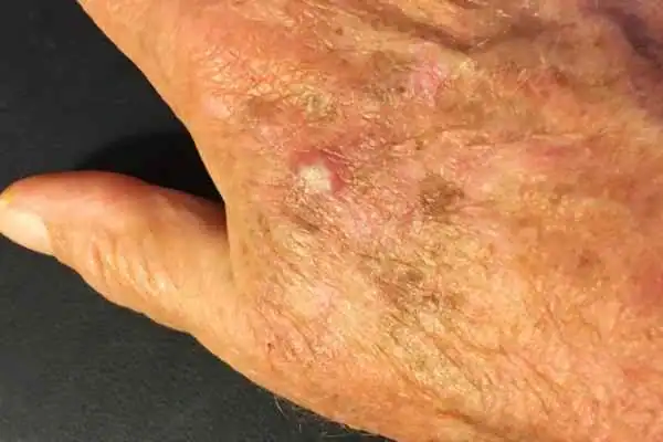 Image of Actinic keratoses Hertford on a person hand