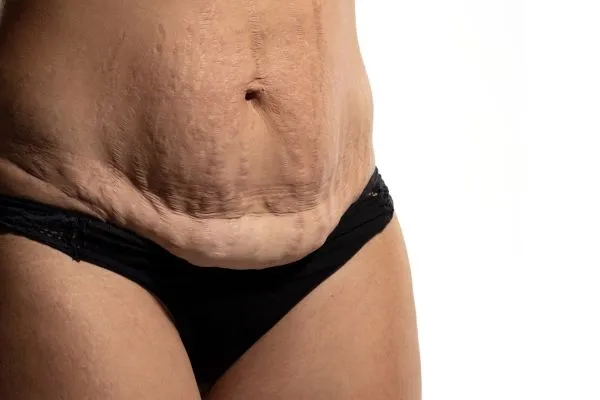 The Science of Skin Tightening 1 The science behind skin tightening Hertford picture of a woman's sagging skin on the stomach